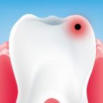 مراحل تسوس الأسنان