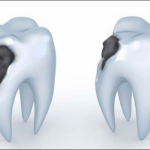 تسوس الأسنان: أسبابه وأعراضه وأثره في حياتك