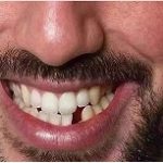 9 أسباب محتملة قد تكلفك أسنانك و10 طرق لتفادي تساقط الأسنان وبالتالي تجنب فقدان الأسنان