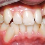 حالات الشذوذ في شكل الأسنان (تبدل شكل الأسنان أو شكل الأسنان غير السليم) Alteration in Shape