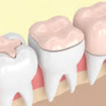 الحشوات الوقائية للأسنان  (سدادات الشقوق والحفر في الأسنان) تعريف الحشوات الوقائية: