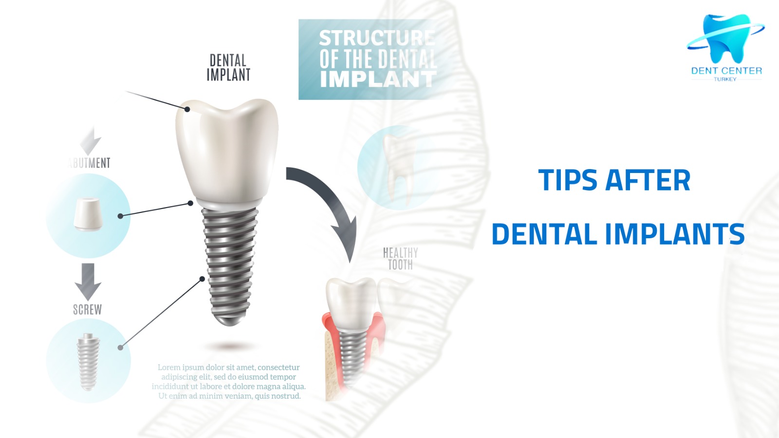 Post-Dental Prosthesis Tips - DentCenterTurkey