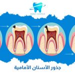جذور الأسنان الأمامية