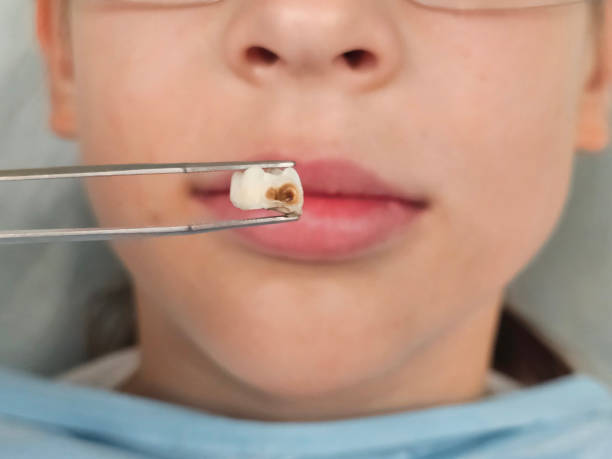 Restoring Decayed Teeth