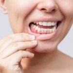 نجاح التجارب السريرية لعلاج التهاب اللثة باستخدام الخلايا الجذعية