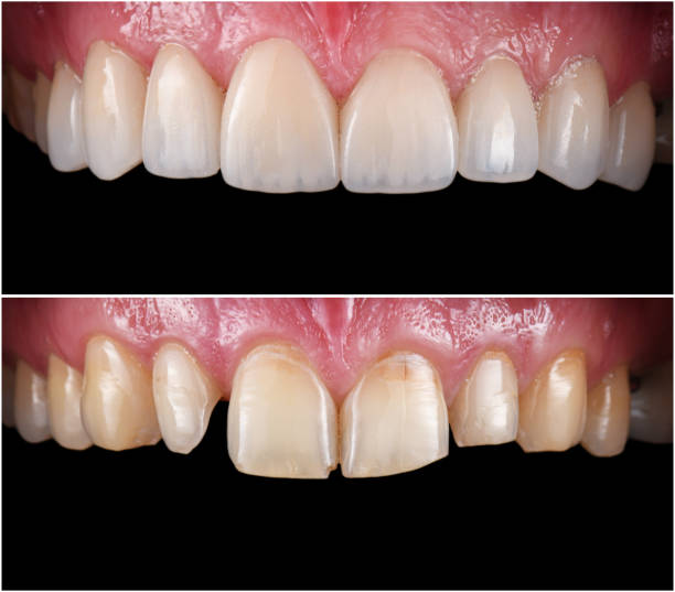 Restoring Broken Teeth