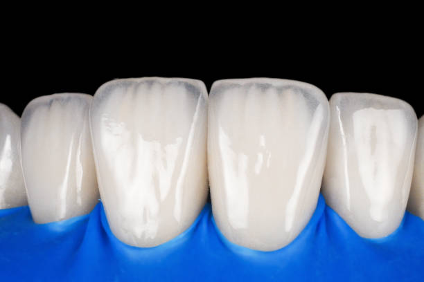 What is the Treatment for Anterior Tooth Erosion?