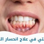 تجربتي في علاج انحسار اللثة