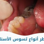 أخطر أنواع تسوس الأسنان