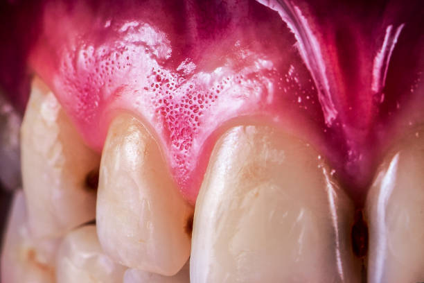 سواد اللثة تحت الأسنان