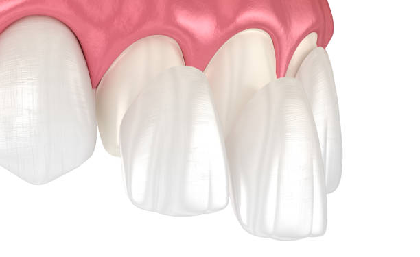ما هو تلبيس الأسنان ثلاثي الأبعاد؟