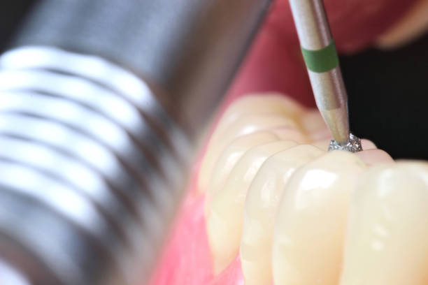 Is Dental Crystal Placement Forbidden?