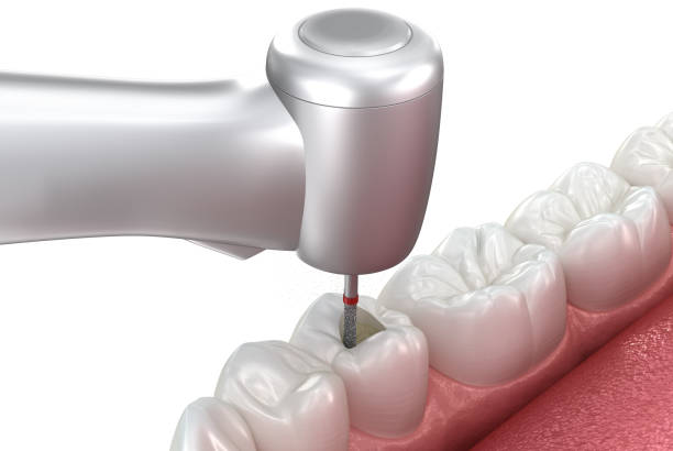 Cost of Dental Crystal Placement