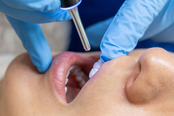 Tooth Diamond Placement