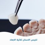 تلبيس الأسنان ثلاثية الأبعاد