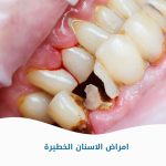 أمراض الأسنان الخطيرة