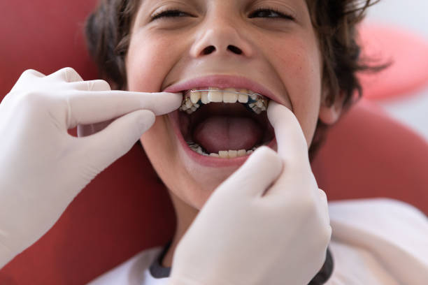 سعر تقويم الأسنان الفك العلوي فقط