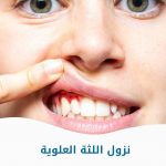 نزول اللثة العلوية