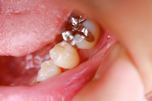 The Best Types of Dental Fillings