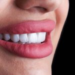 أسئلة شائعة عن تلبيسات الزيركون