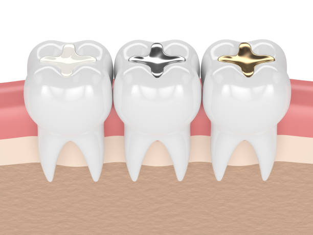 Types of Dental Fillings