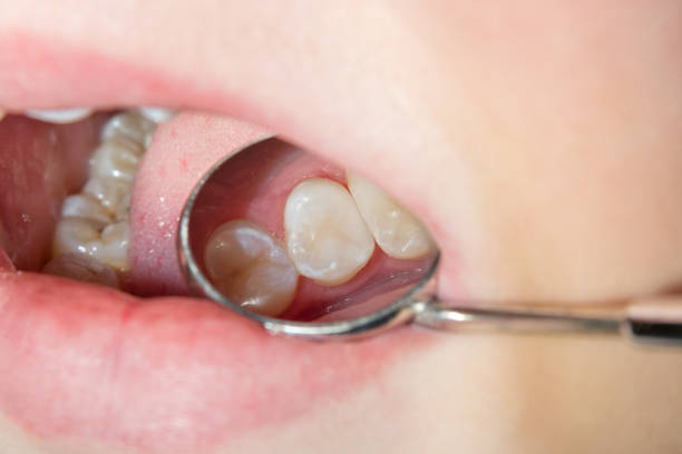 Types of Dental Fillings and Their Prices