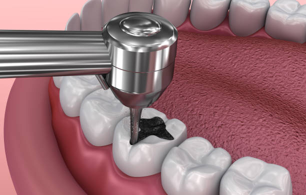 Tips After Molar Filling