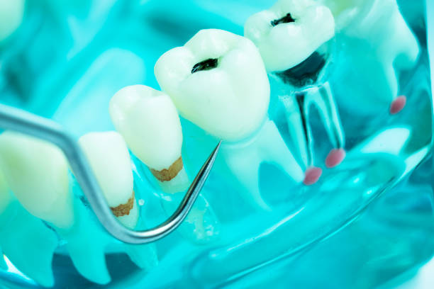 Types of Permanent Dental Fillings