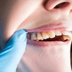 مدة علاج العضة المفتوحة