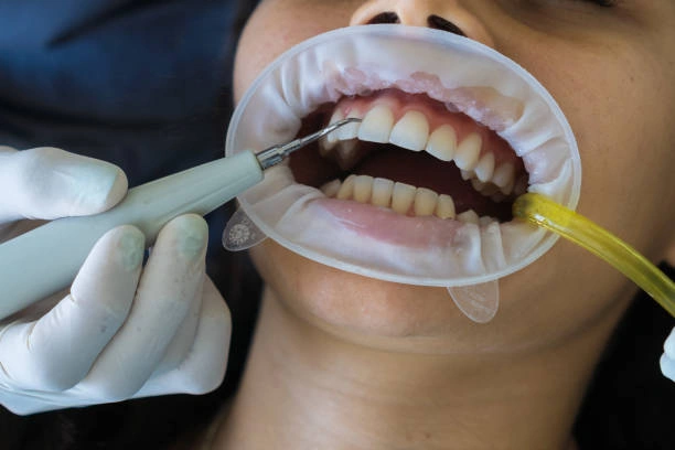تقنية Guided Biofilm Therapy