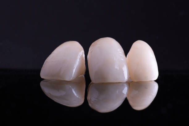 Difference Between Zirconia and E-max