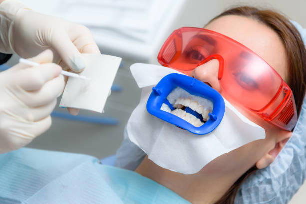 هل تبييض الأسنان آمن؟