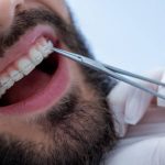 تقويم الأسنان في تركيا