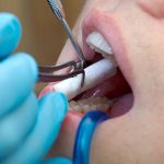 تلبيس الأسنان (التيجان) في تركيا