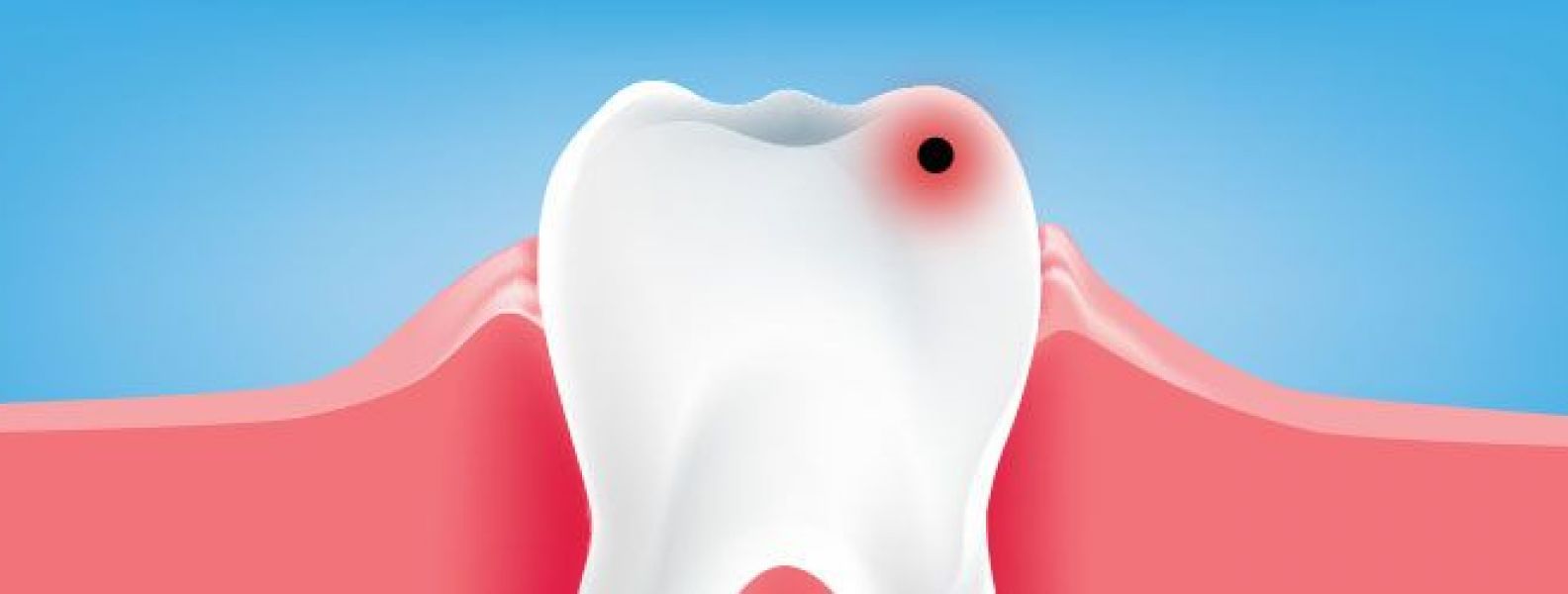 مراحل تسوس الأسنان - DentCenterTurkey