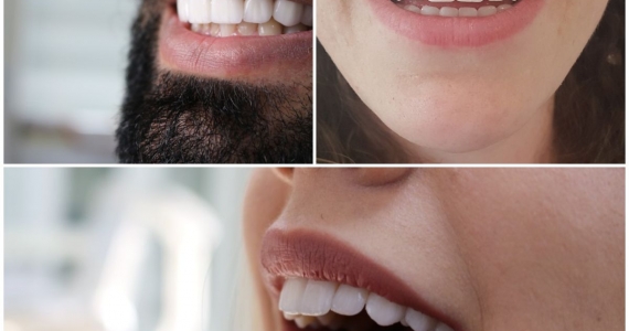 Pictures of Hollywood Smile performed at our clinic in Istanbul, Turkey
